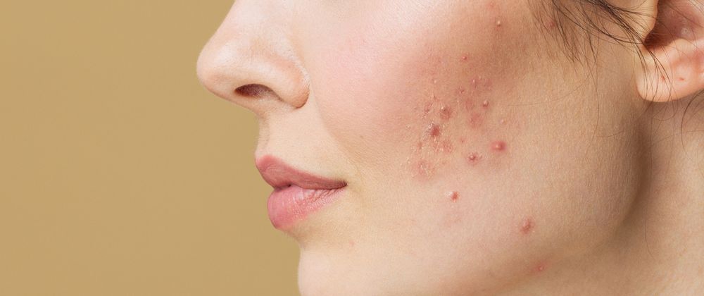 Cover image for Is Hydra Facial Effective for Wrinkles