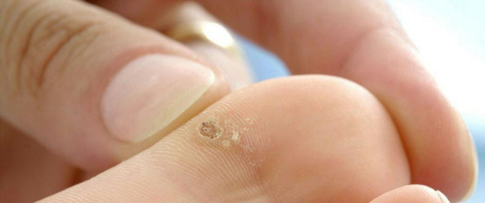 Cover image for Is Wart Removal Different for Teens?