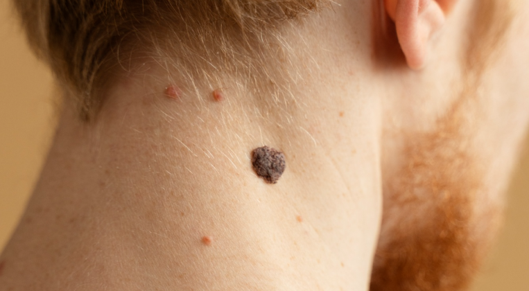 Cover image for Is Wart Removal Different for Teens?
