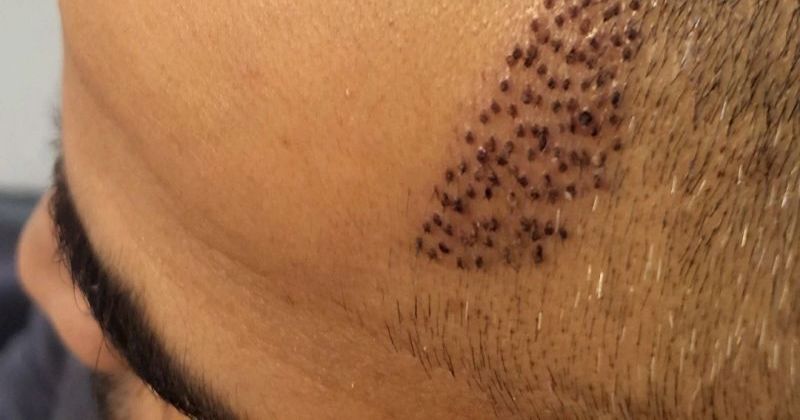 Cover image for Does Hair Transplant Leave Any Scars?