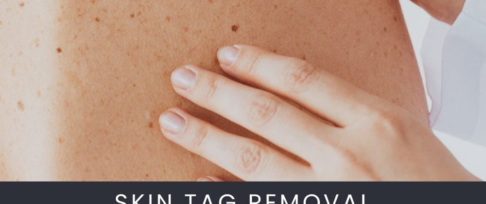 Cover image for Skin Tag Treatment: What Works and What to Avoid