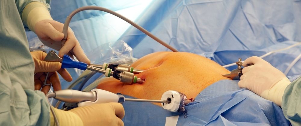 Cover image for Is Laparoscopic Surgery Better Than Open Surgery?