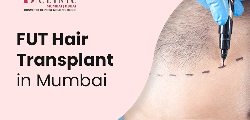 Cover image for Benefits of Considering FUT Hair Transplant