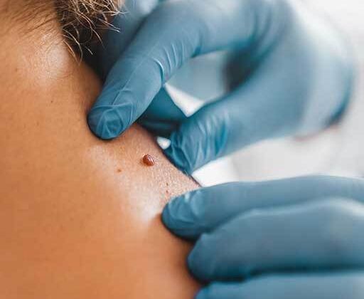 Cover image for What Skin Types Are Ideal for Removal?